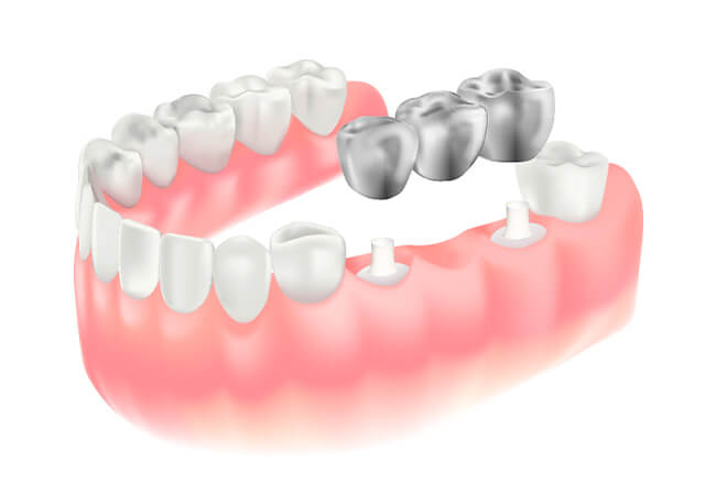 ブリッジ（両隣の歯を支えにして抜いた歯の部分を補う治療）