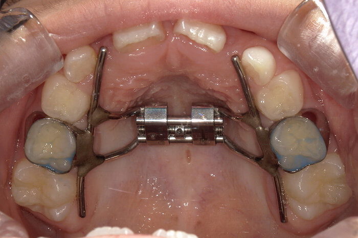 固定式側方拡大装置
