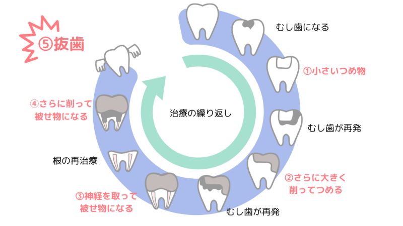 虫歯の進行