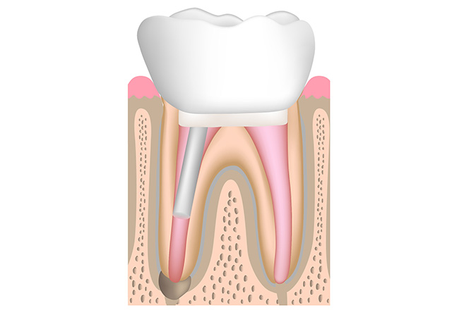 支台築造と被せ物