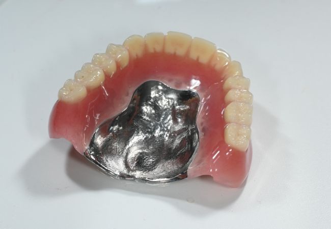 金属床義歯