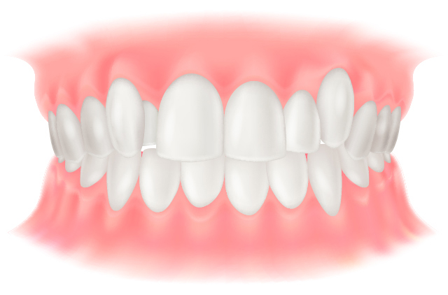 叢生（そうせい）（乱ぐい歯・八重歯）